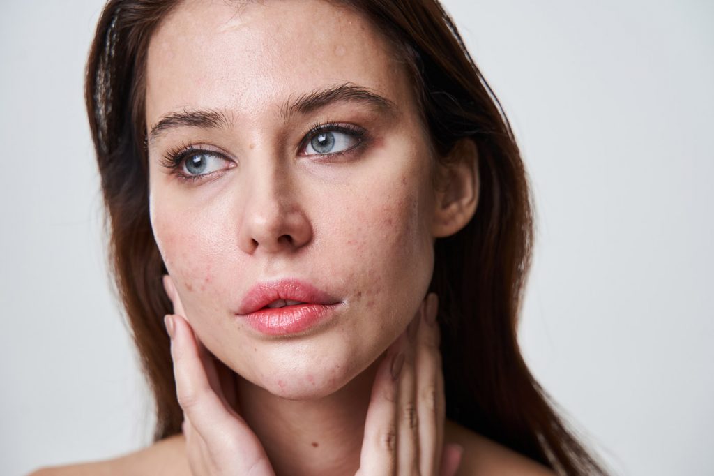 Effective Treatments for Acne