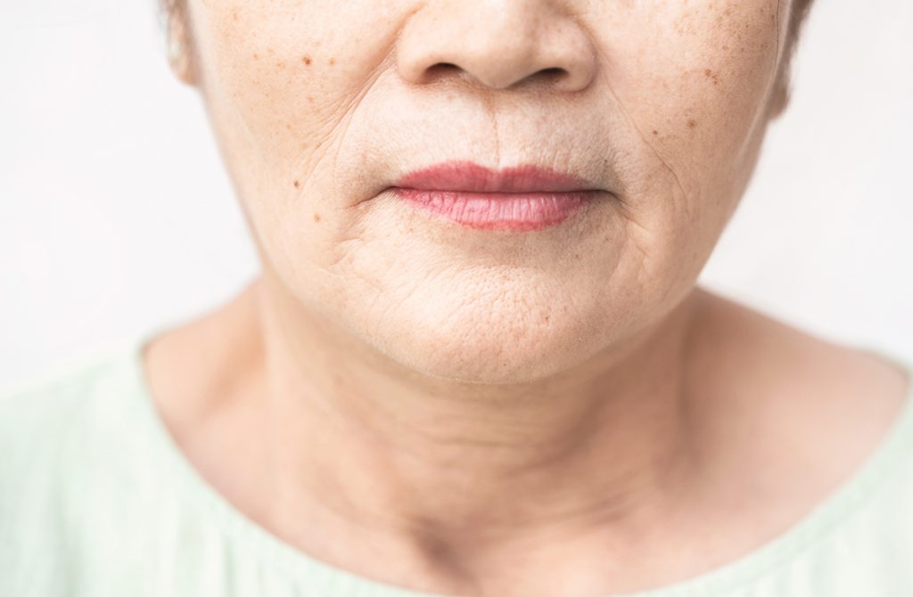 How to Get Rid of Lines Around the Mouth