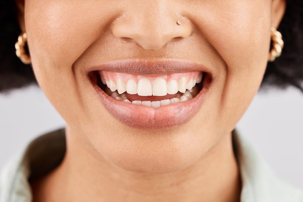 How to Get Rid of a Gummy Smile