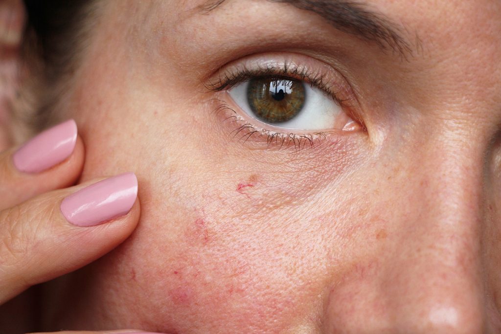 Are Facial Aesthetic Treatments Suitable for People with Sensitive Skin?