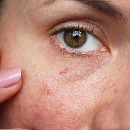 Are Facial Aesthetic Treatments Suitable for People with Sensitive Skin?